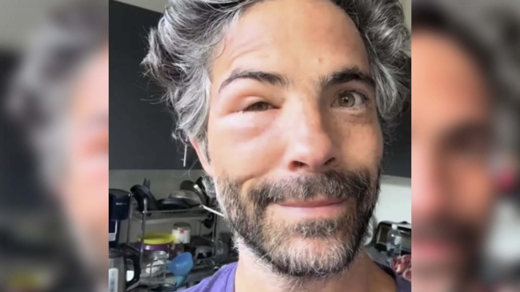 Osvaldo Benavides aparece con rostro desfigurado: ¿qué le pasó?