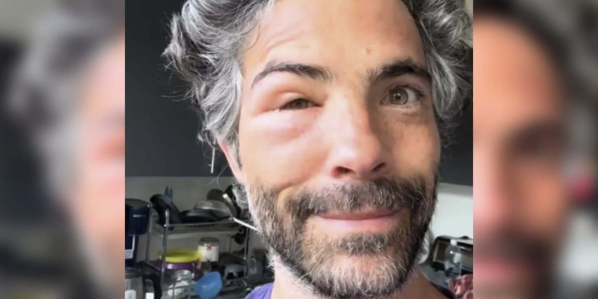 Osvaldo Benavides aparece con rostro desfigurado: ¿qué le pasó?